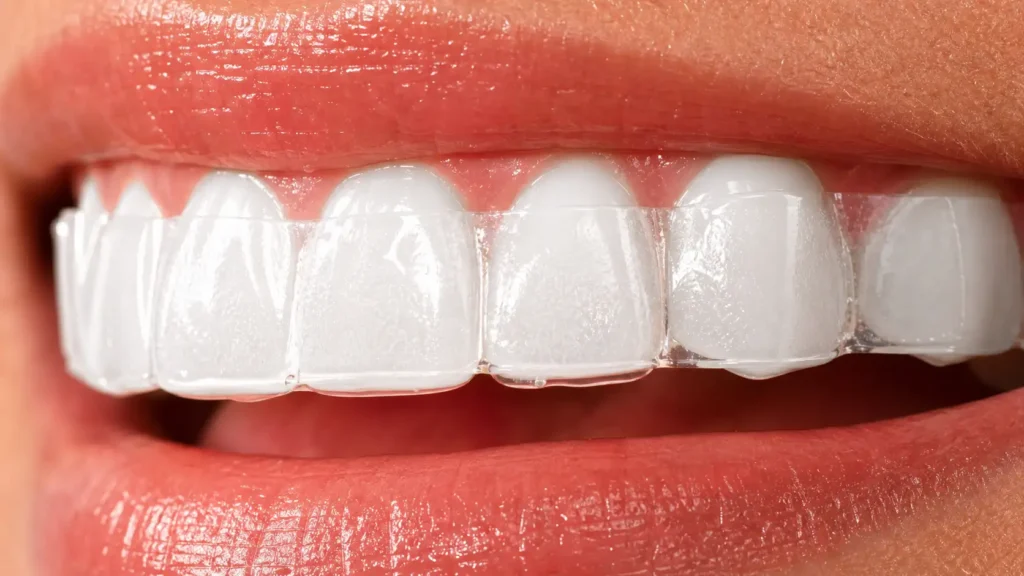 Macro detail of Crest 3DWhitestrips adhering tightly to teeth enamel for fast whitening before prom